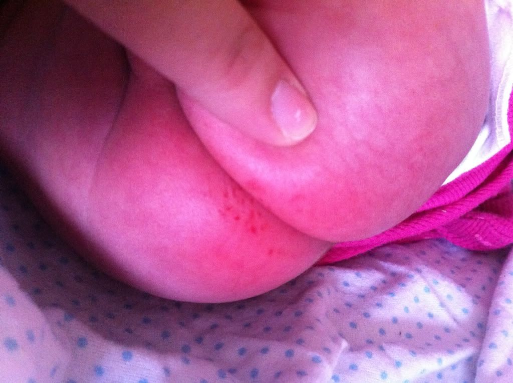 Is this a yeast rash with pic - BabyCenter